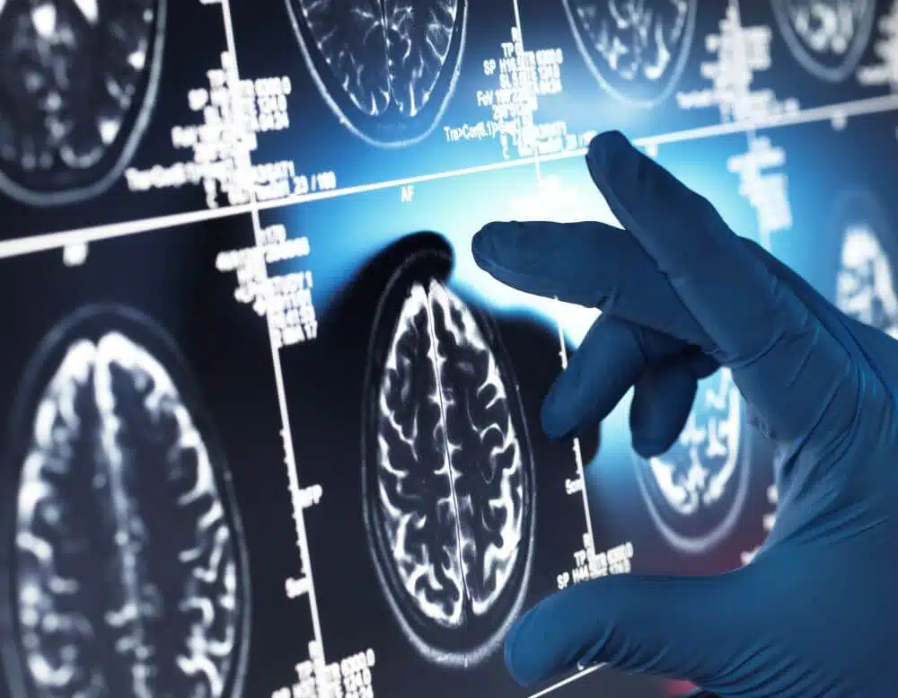 A hand examining an x-ray of a brain - CGH Injury Lawyers