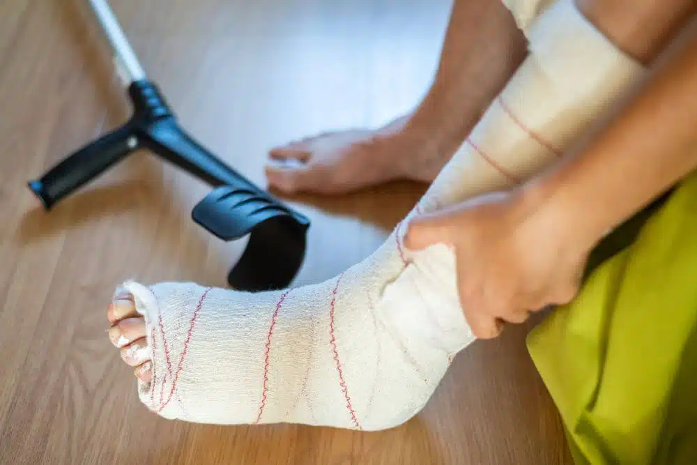 Leg with cast - CGH Injury Lawyers